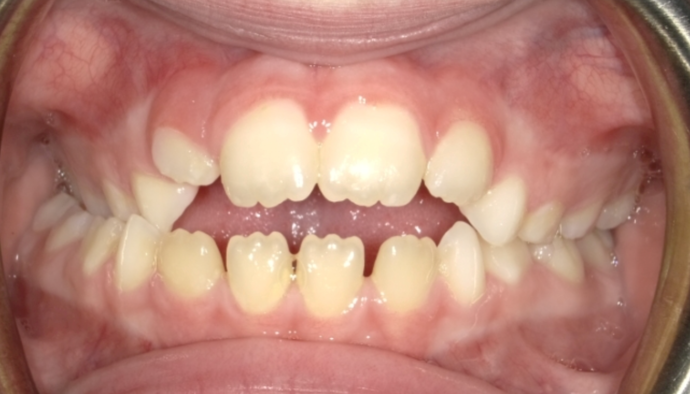 openbite closeup of patient teeth callan orthodontics lawrenceville nj