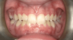 overbite-before-2