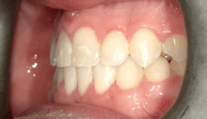 underbite-1-after