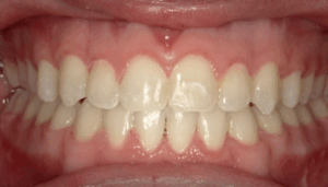underbite-2-after