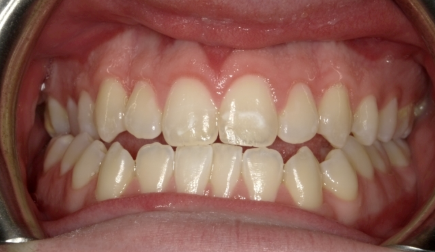 underbite-2-before