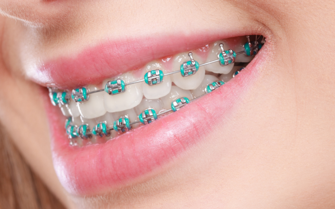Adult Braces: Is It Too Late to Straighten Teeth?