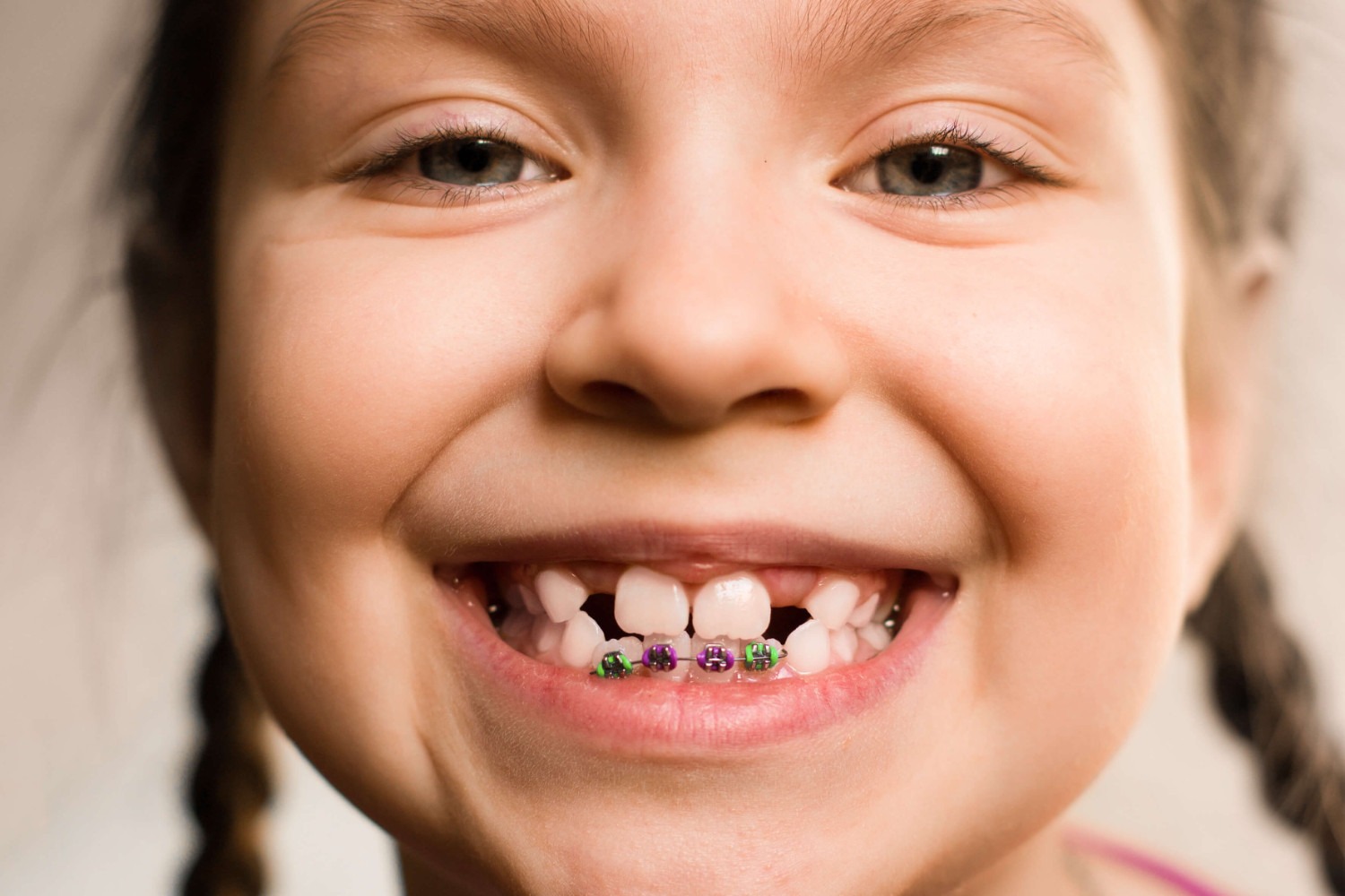girl with white banded braces