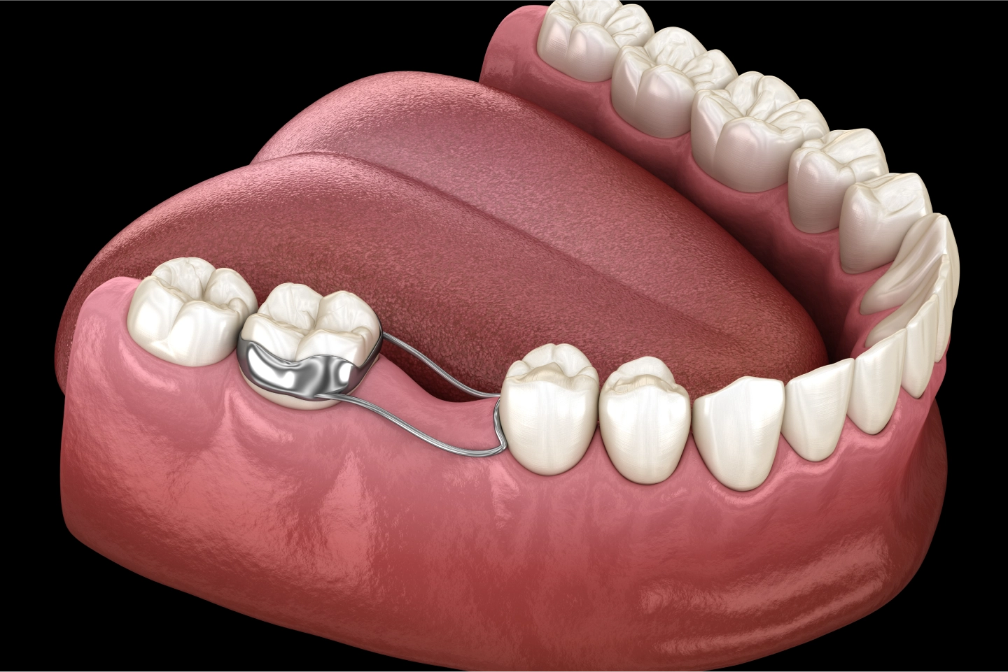 little girl with colorful partial braces callan orthodontics