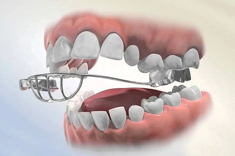 Early Orthodontic Evaluation for Kids | Lawrenceville, NJ