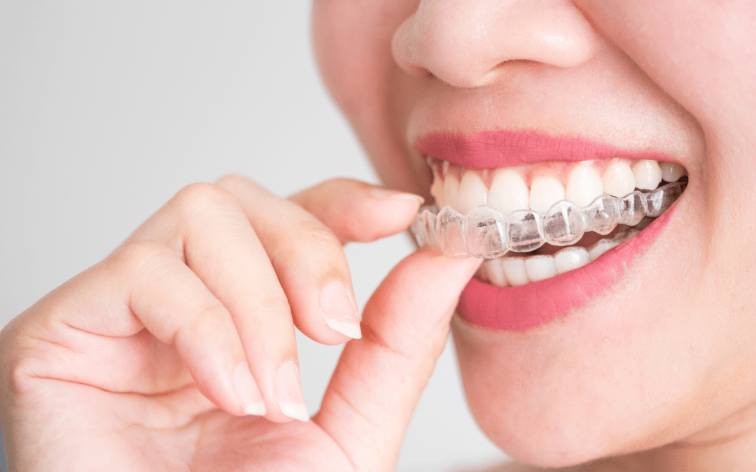 Is Invisalign as Effective as Braces for Severe Crowding?